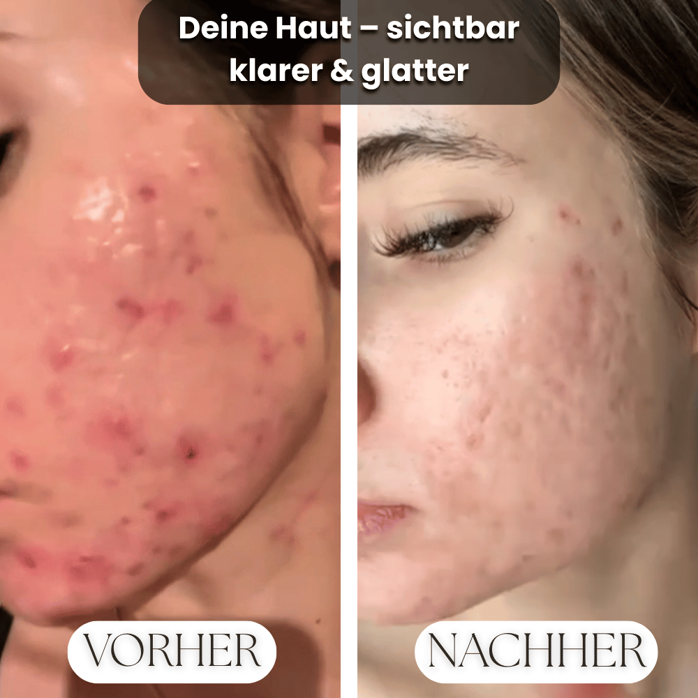 Vorher-Nachher Hautergebnis – reine, glatte Haut statt Akne & Pickel dank Premium Spa Set 7in1 mit LED-Lichttherapie und Hochfrequenz-Technologie.