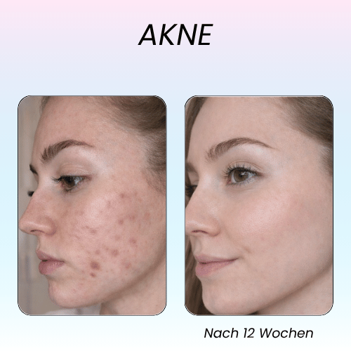 LumeaGlow- 7 Farben LED Maske